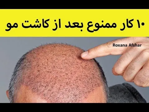کاشت مو