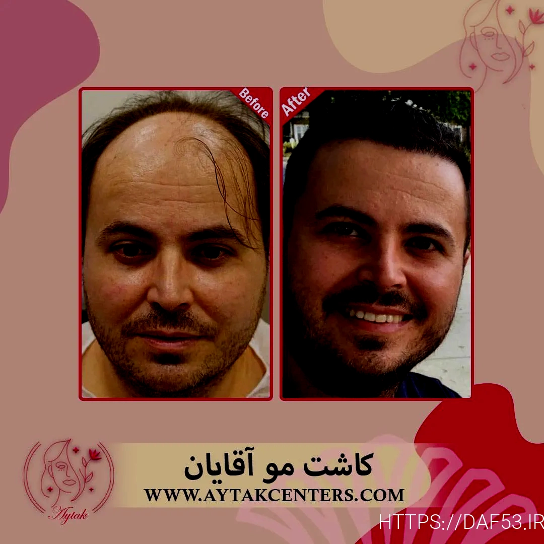 کاشت مو