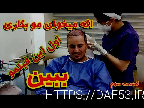 کاشت مو